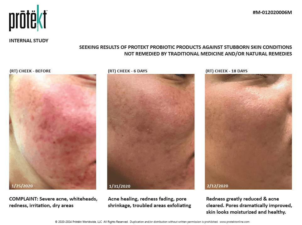 Probiotic skin repair serum rosacea before and after – cheek improvement after 18 days of use